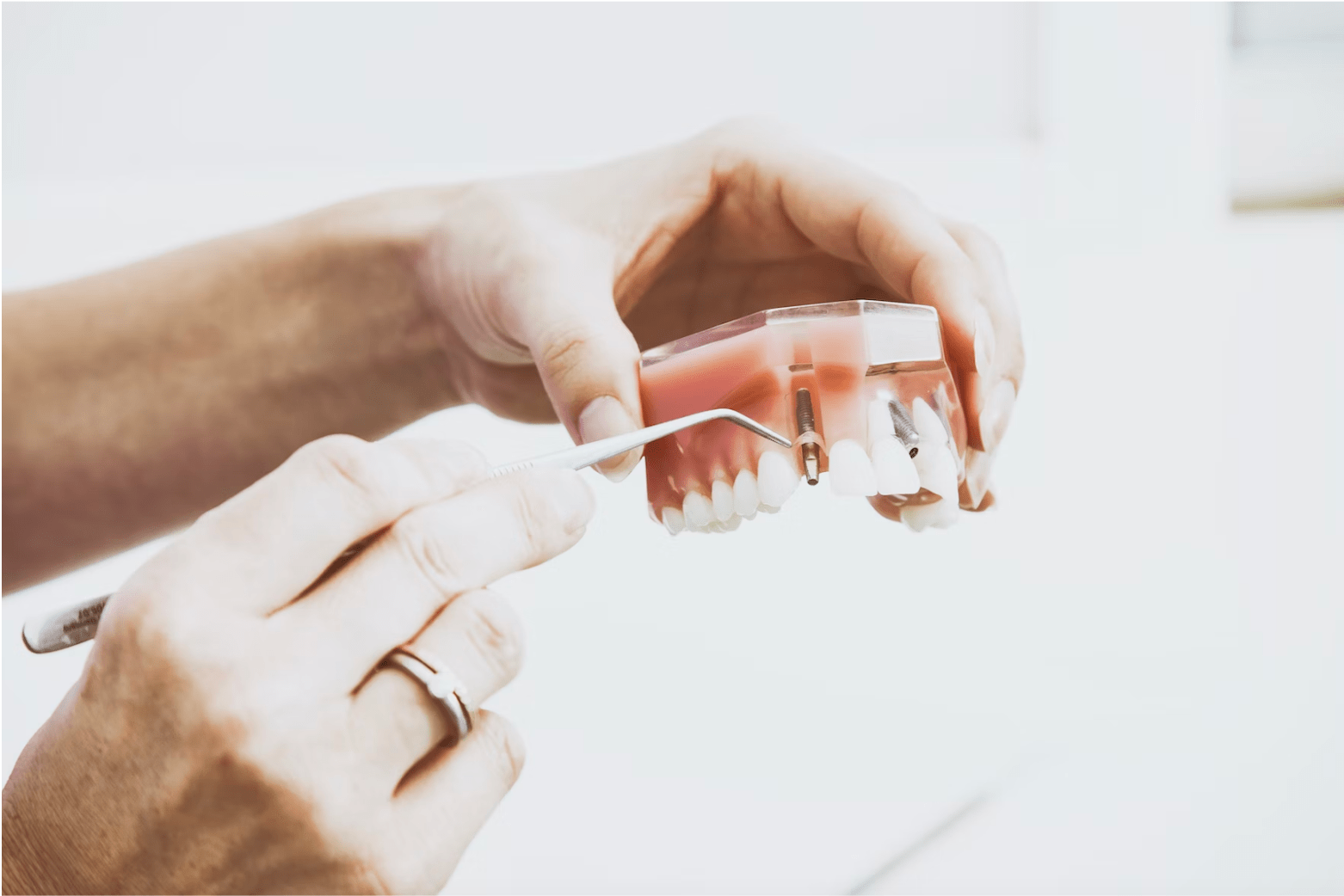 Dental Implants Deakin Canberra